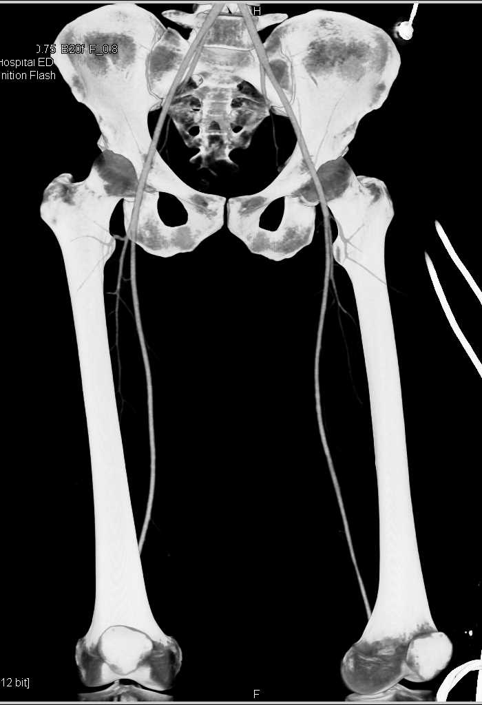 Normal CTA Runoff - CTisus CT Scan