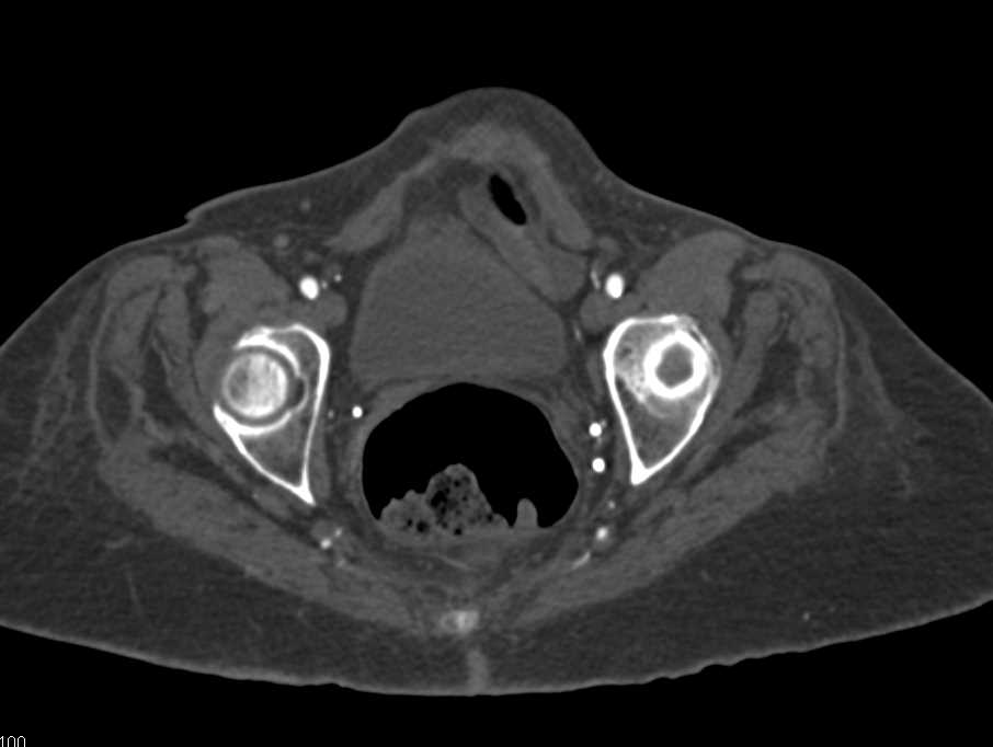 CTA Runoff with Peripheral Vascular Disease - CTisus CT Scan