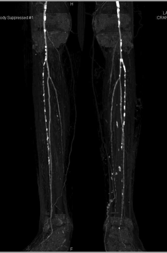 CTA Runoff with Peripheral Vascular Disease - CTisus CT Scan