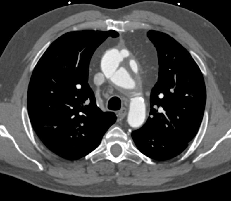 Type A Dissection - CTisus CT Scan