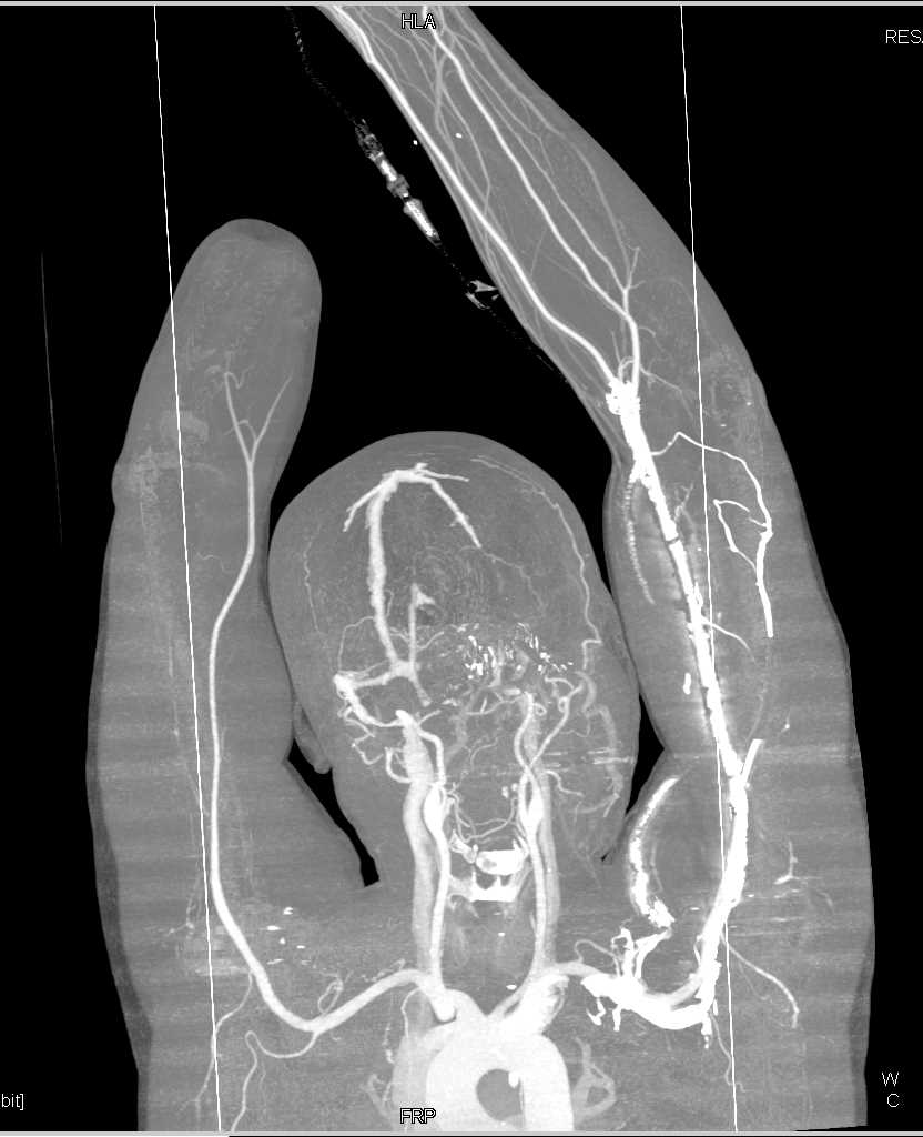 CTA Map in Patient s/p Amputation for Vascular Reconstruction - CTisus CT Scan