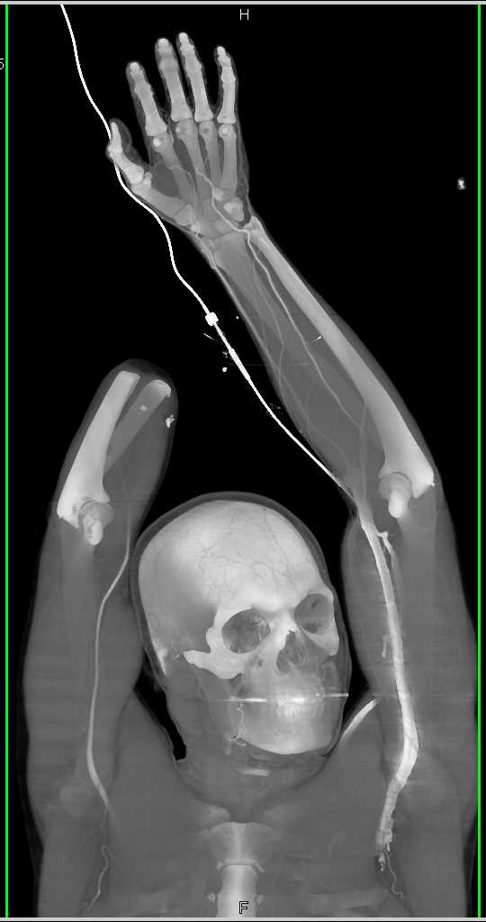 CTA Map in Patient s/p Amputation for Vascular Reconstruction - CTisus CT Scan