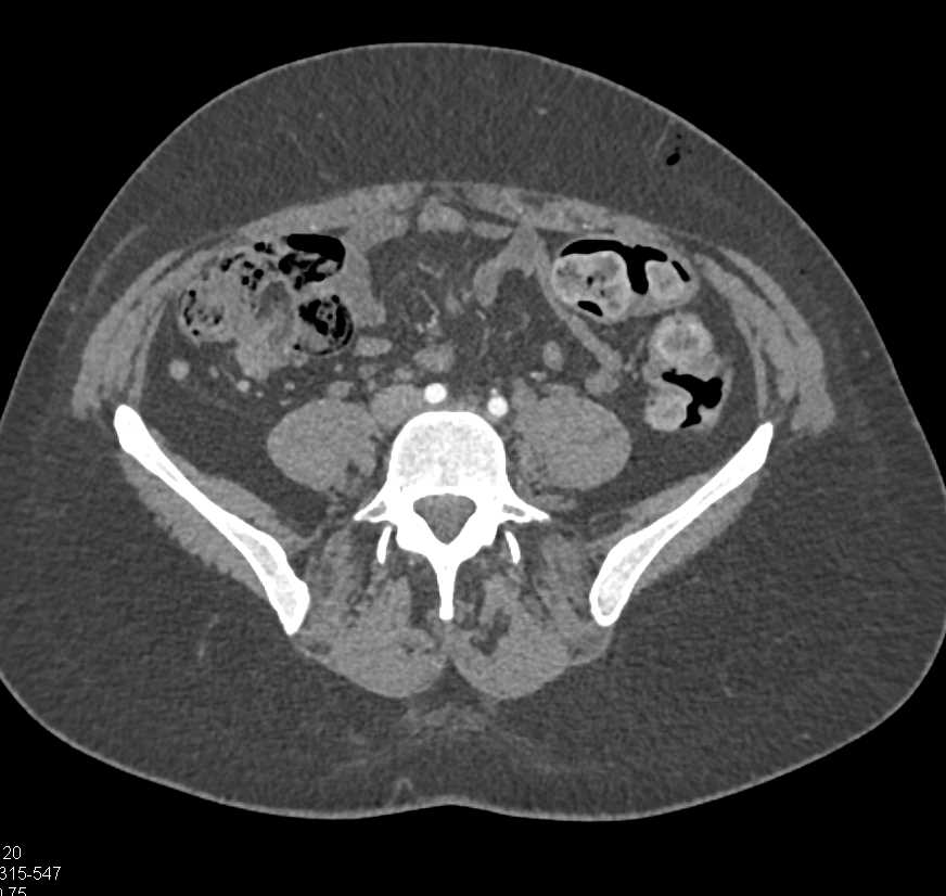 Left Femoral Vein Thrombosis - CTisus CT Scan