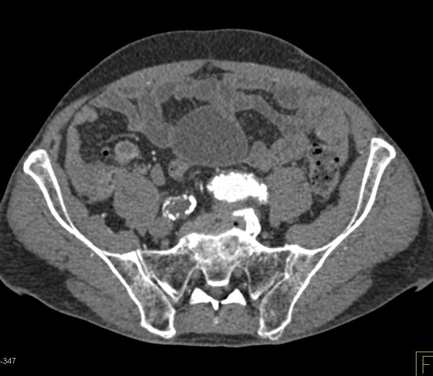 Aortic Grafts with Fem-Fem Bypass - CTisus CT Scan