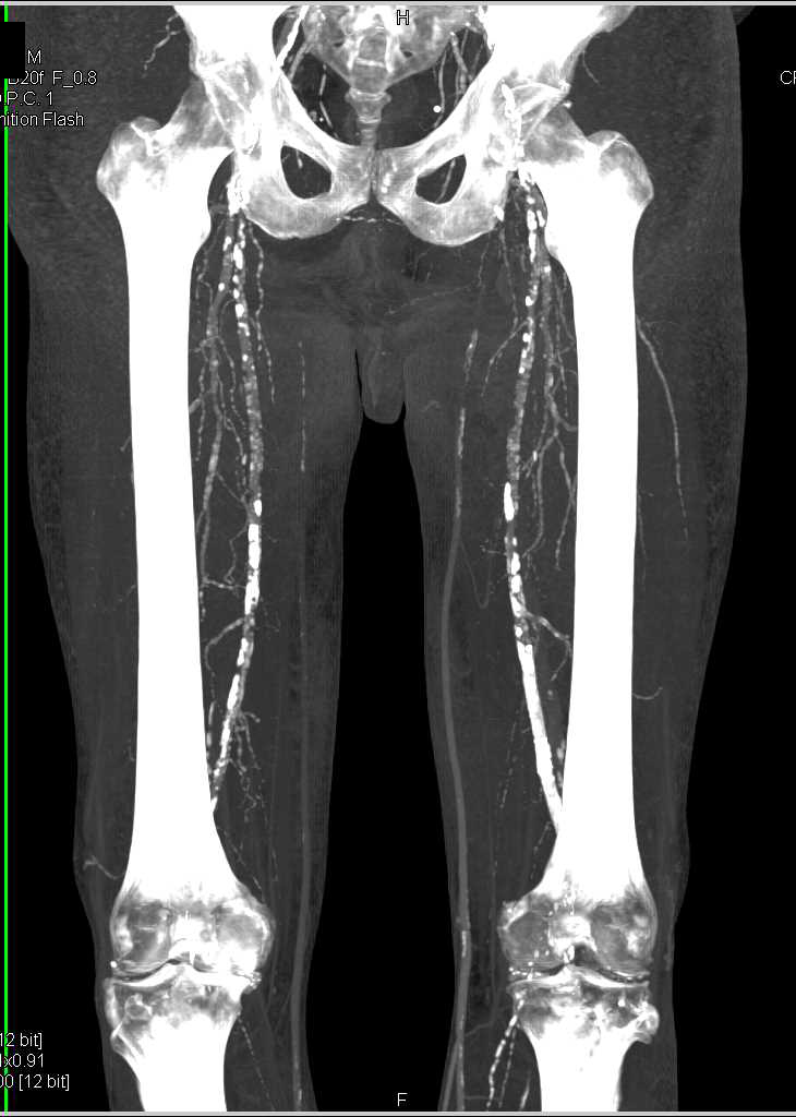 Extensive Peripheral Vascular Disease on CTA Runoff - CTisus CT Scan