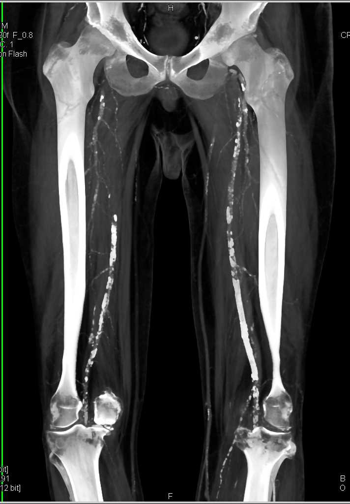 Extensive Peripheral Vascular Disease on CTA Runoff - CTisus CT Scan