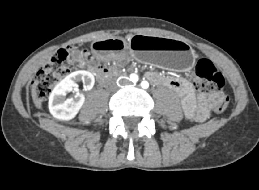 Stent in Left Iliac Vein in Patient with MayThurner Syndrome (MTS) - CTisus CT Scan