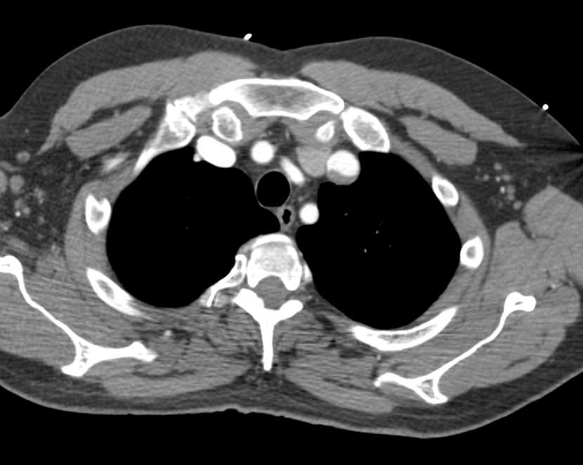 Ehlers-Danlos Syndrome with Bleeding Right Renal Artery Aneurysm - CTisus CT Scan