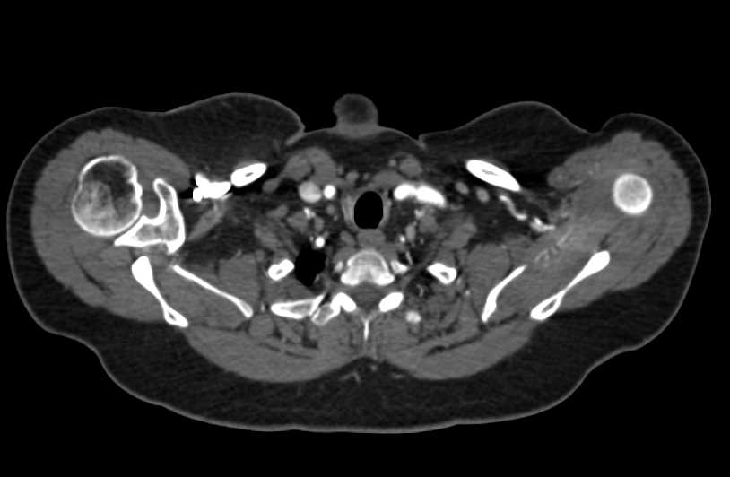 Occluded Proximal Lef tSubclavian Artery with Bypass Graft from Left Carotid to Left Subclavian Artery - CTisus CT Scan