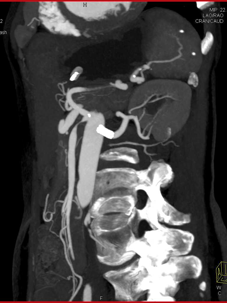 High Grade Stenosis of the SMA - CTisus CT Scan