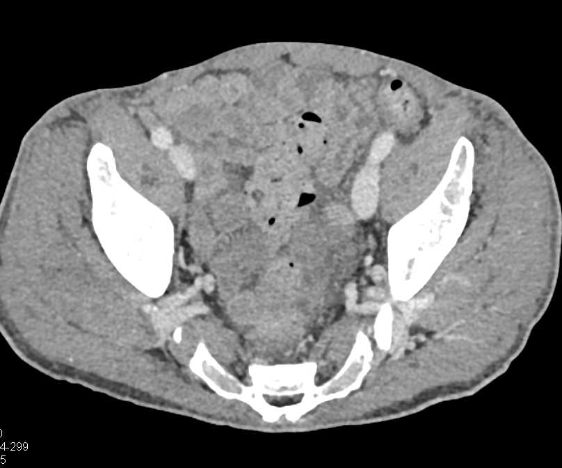 Pseudo-aneurysm Right Gluteus Muscle in Patient wit Prior Biopsy of the Iliac Crest in Patient with Lymphoma - CTisus CT Scan