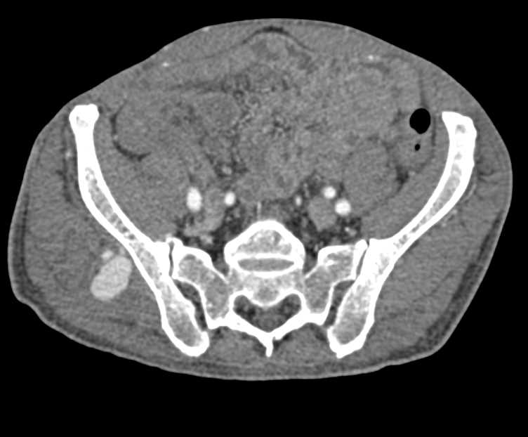 Pseudo-aneurysm Right Gluteus Muscle in Patient wit Prior Biopsy of the Iliac Crest in Patient with Lymphoma - CTisus CT Scan