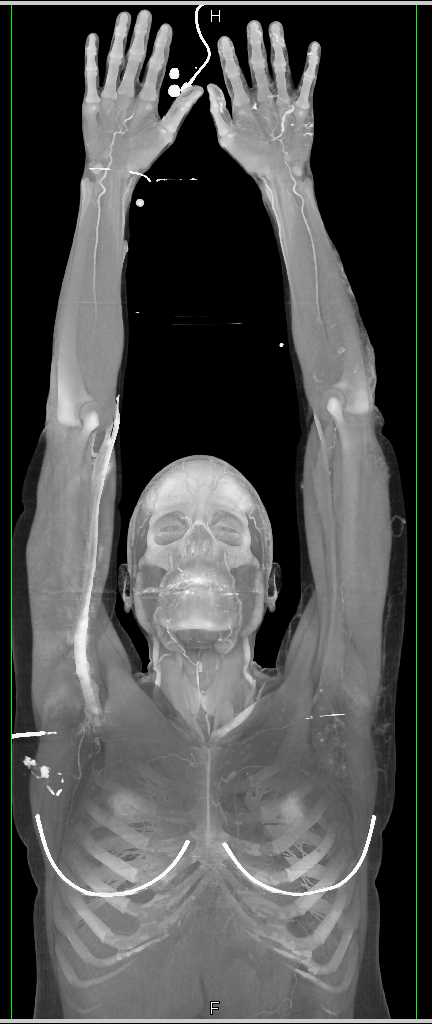 CTA of the Upper Extremities - Vascular Case Studies - CTisus CT Scanning