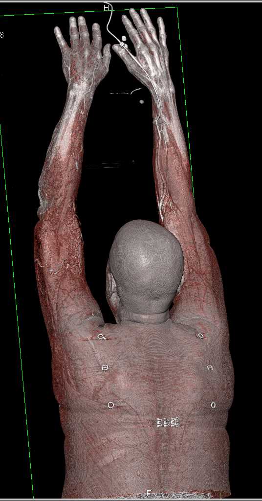 CTA of the Upper Extremities - CTisus CT Scan