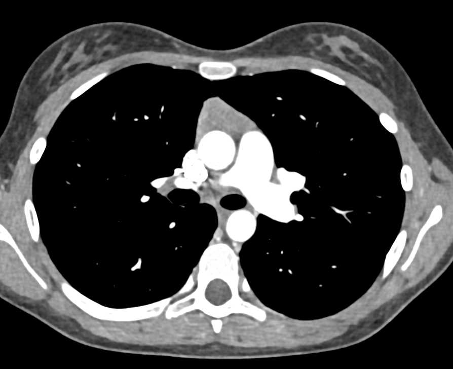 Multiple Pulmonary Arteriovenous Malformations (PAVMs) - CTisus CT Scan