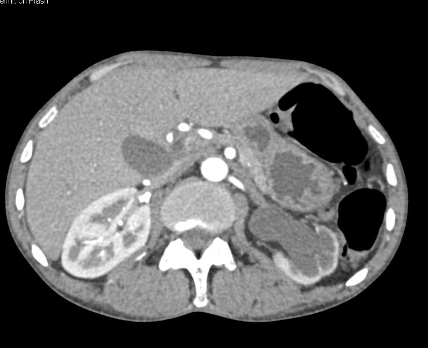 Incidental Tumor Bladder in Patient with Severe Peripheral Vascular Disease (PVD) - CTisus CT Scan