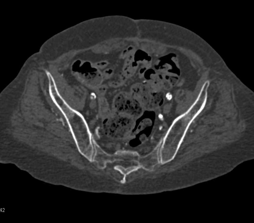 CTA Runoff with Extensive Peripheral Vascular Disease - CTisus CT Scan