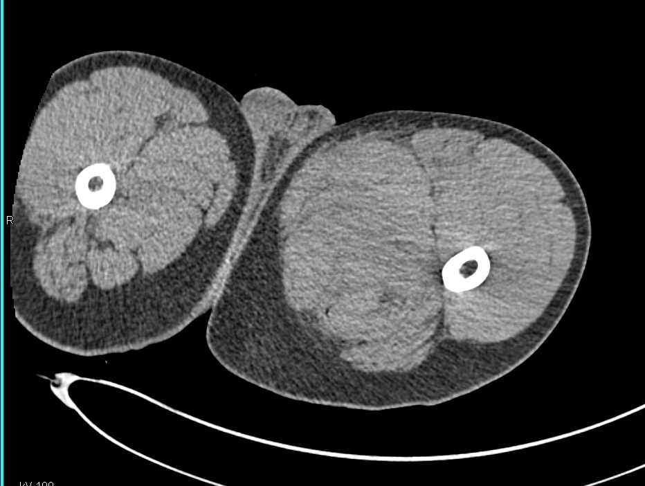 Active Bleed from Pseudoaneurysm Left Thigh - CTisus CT Scan