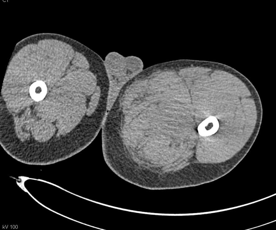 Active Bleed from Pseudoaneurysm Left Thigh - CTisus CT Scan