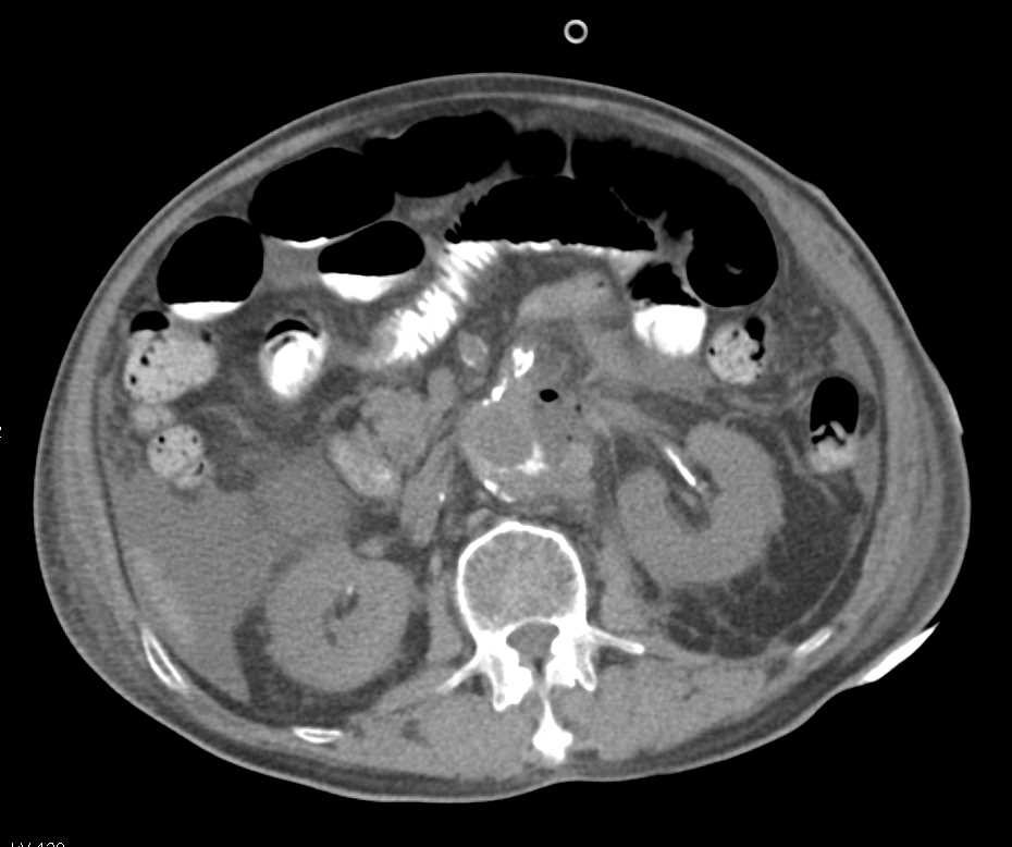 Active Bleed from Endovascular Stents - CTisus CT Scan