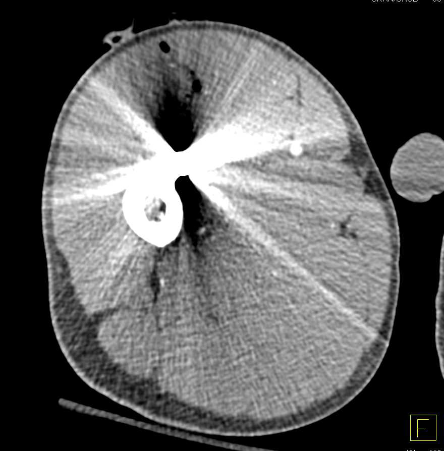 GSW Thigh Without Vascular Injury on CTA - CTisus CT Scan