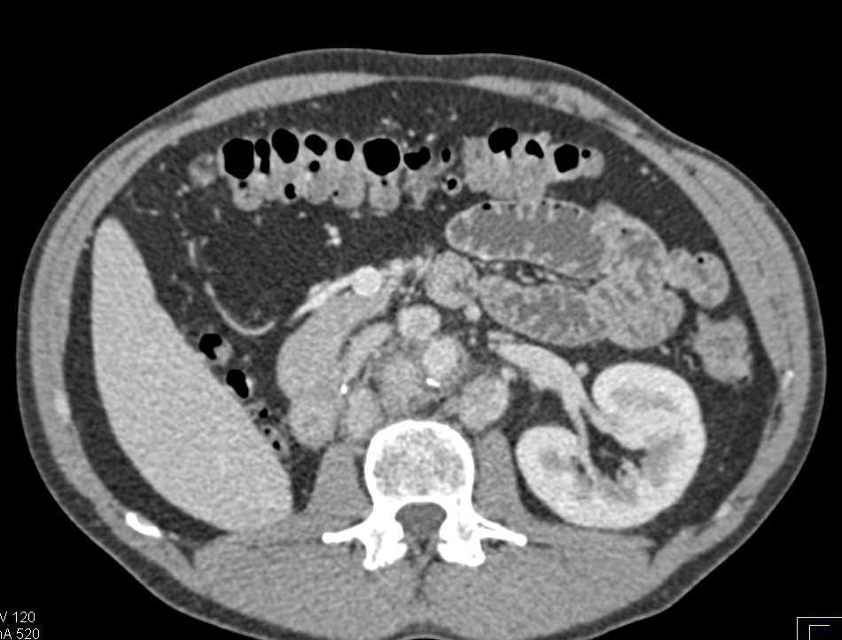 Vascular Grafts in Renal Cell Carcinoma Patient with Patient Vascular Map - CTisus CT Scan