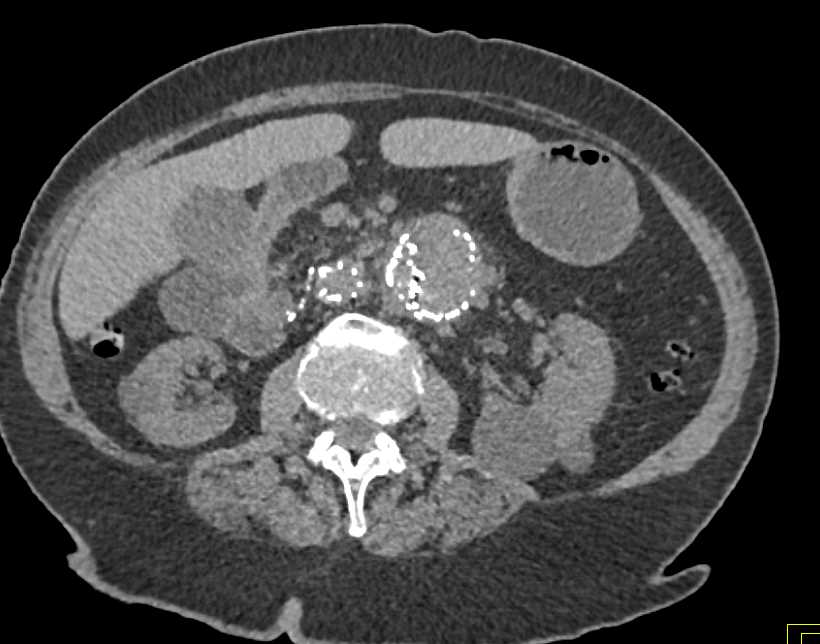 Fibromuscular Dysplasia Both Renal Arteries in a Patient with an Endovascular Stent - CTisus CT Scan