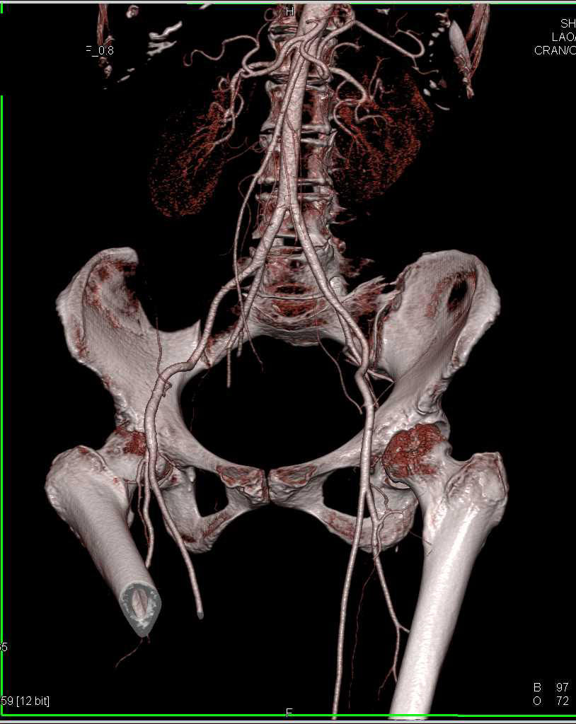 DE CTA Post Trauma Without Vascular Injury - CTisus CT Scan