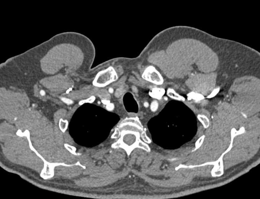 Aortic Occlusion with Collaterals Including Failed Grafts - CTisus CT Scan