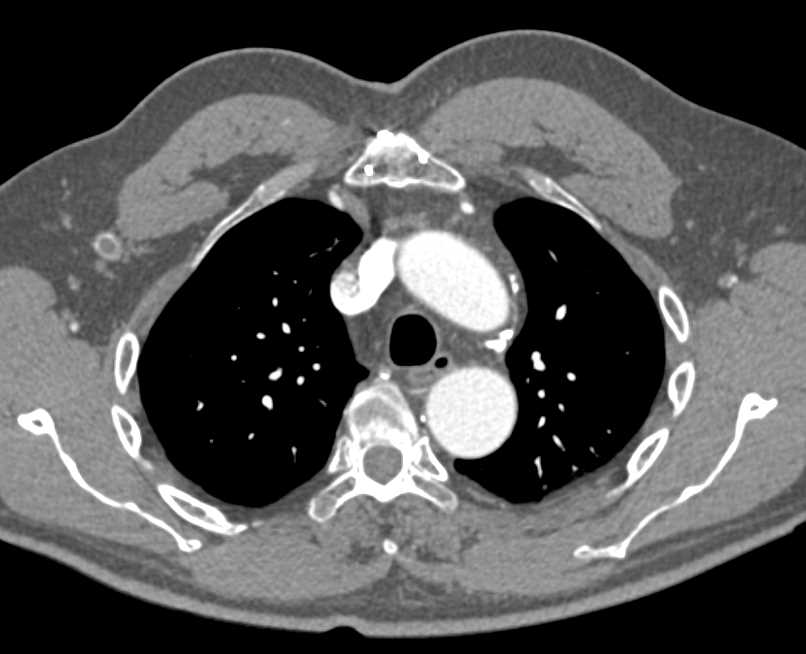 Aortic Occlusion with Collaterals Including Failed Graft Including Right Axillary-Fem Bypass Grafts - CTisus CT Scan