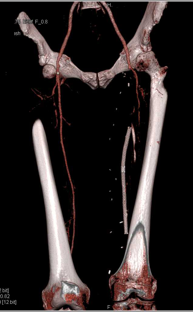 CTA Runoff with Occluded Left Superficial Femoral Artery (SFA) and Occluded Graft - CTisus CT Scan