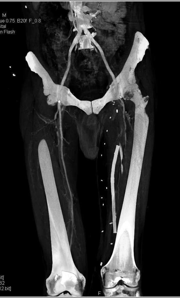 CTA Runoff with Occluded Left Superficial Femoral Artery (SFA) and Occluded Graft - CTisus CT Scan