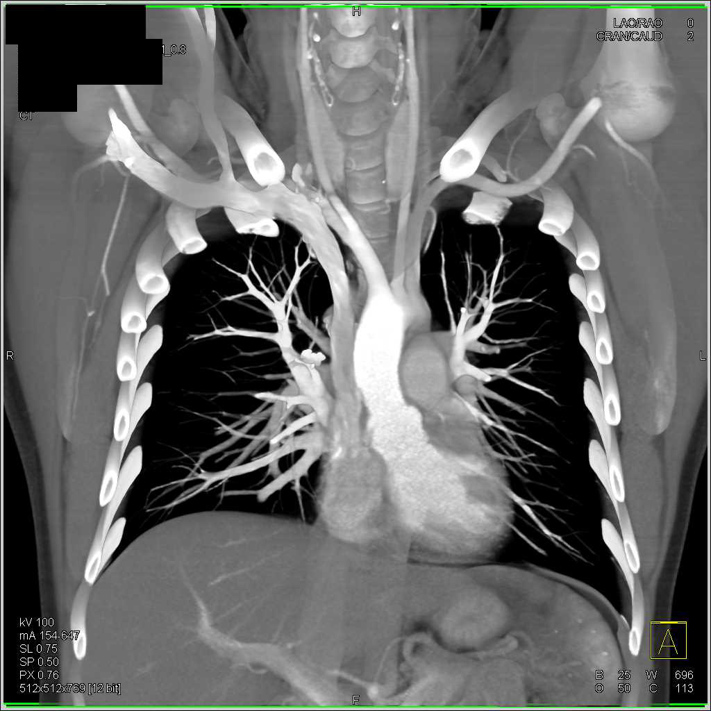 Patent Subclavian Arteries Without Stenosis - CTisus CT Scan