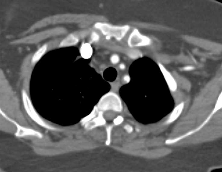 Multiple Plaques in the Left Subclavian Artery - CTisus CT Scan