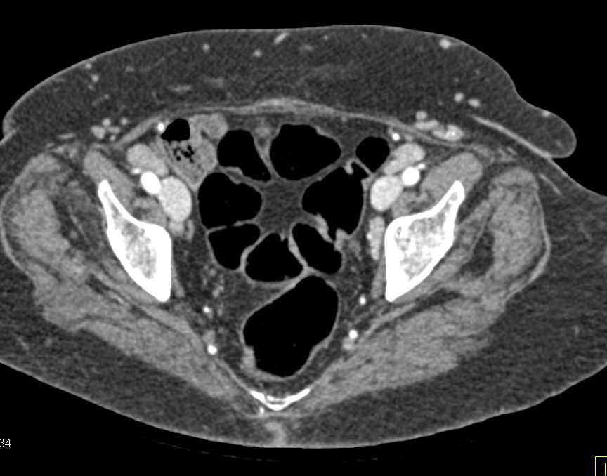 CT Runoff with Early Venous Contamination - CTisus CT Scan