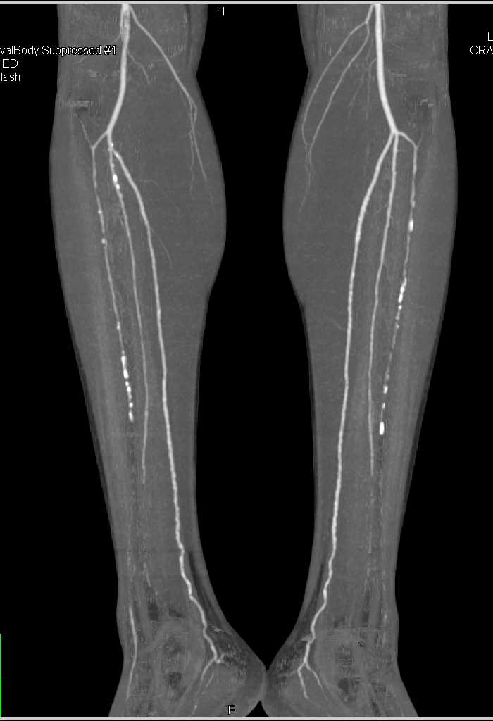 Dual Energy CT with Stents in the Iliac Arteries - CTisus CT Scan