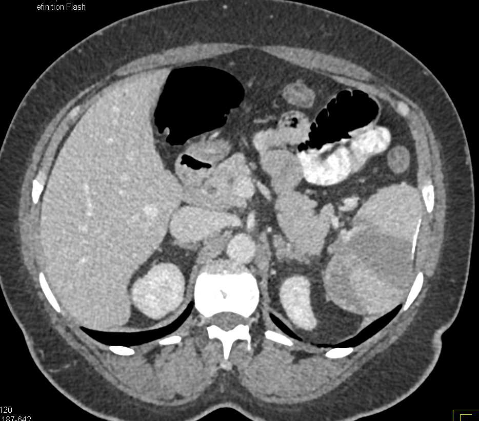 Acute Thrombus in the Left Superficial Femoral Artery (SFA) with Occlusion as well as Splenic Infarcts - CTisus CT Scan