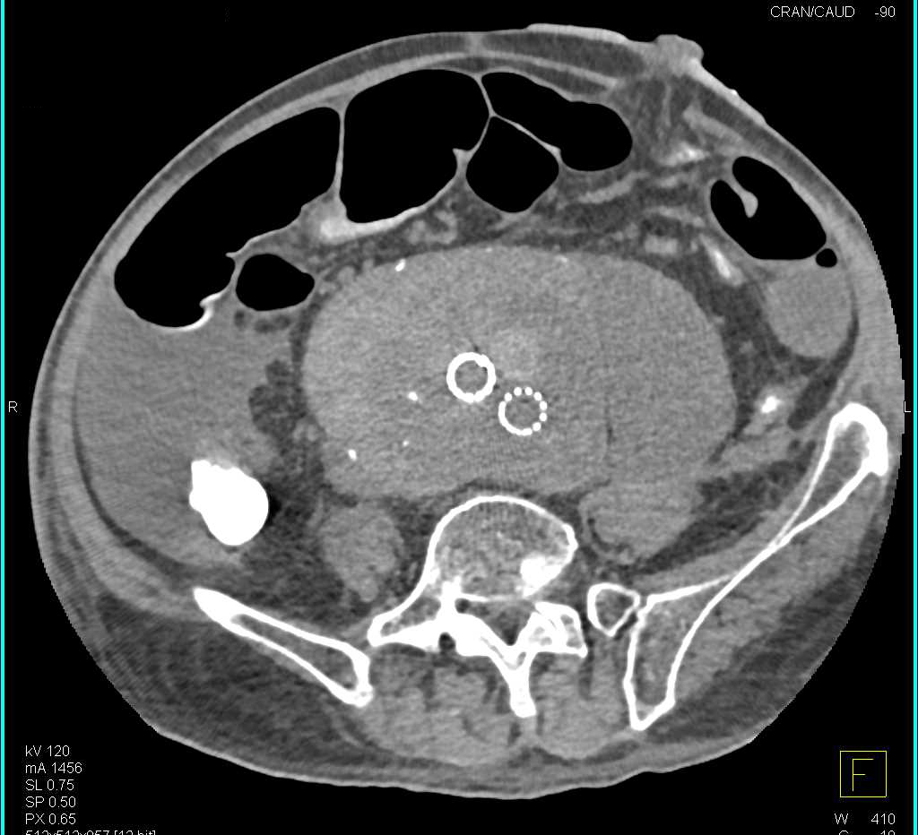 Leaking and Enlarging Abdominal Aortic Aneurysm - CTisus CT Scan