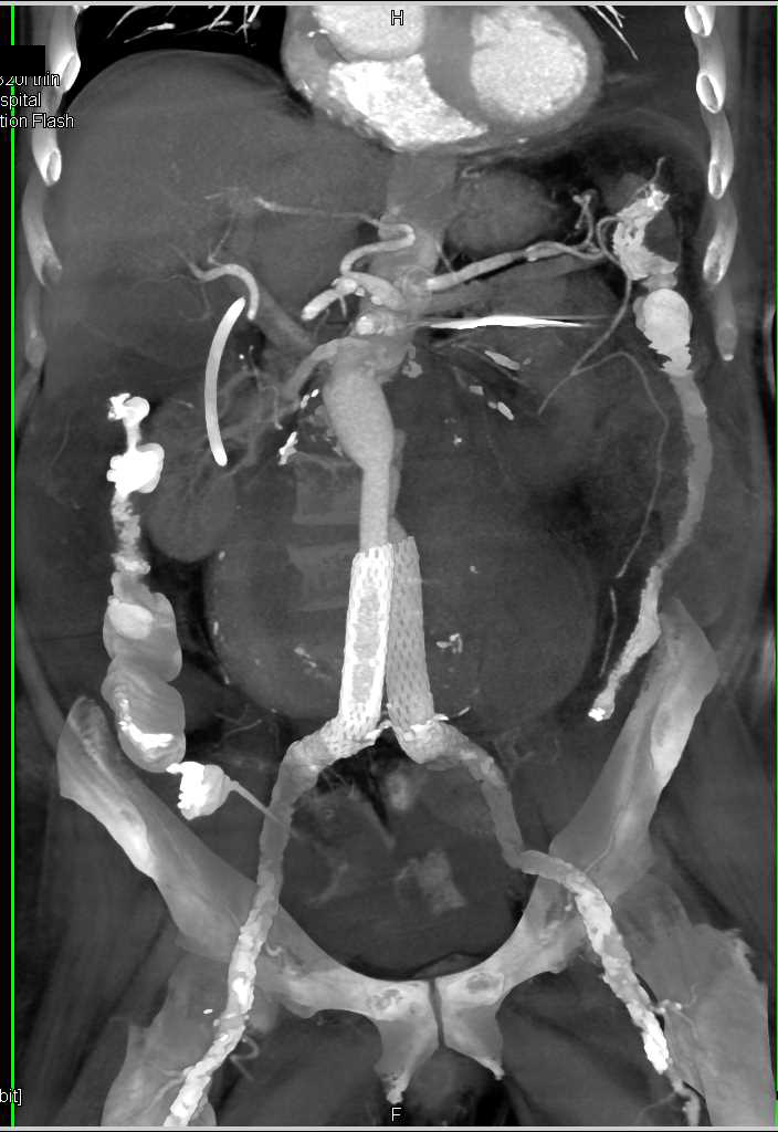 Leaking and Enlarging Abdominal Aortic Aneurysm - CTisus CT Scan