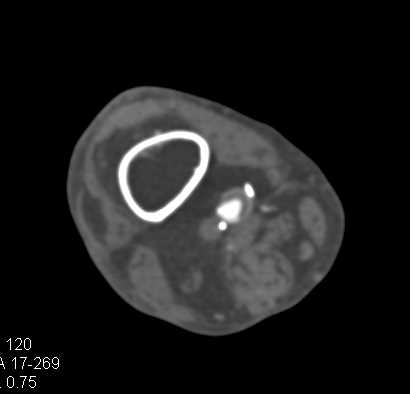 Amazing Graft off Abdominal Aorta to Superficial Femoral Artery (SFA) on 3D - CTisus CT Scan