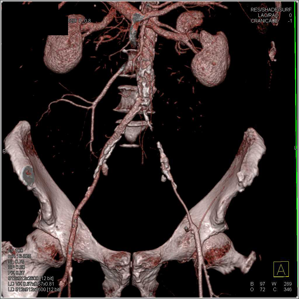 Peripheral Vascular Disease (PVD) with left Common Iliac Occlusion - CTisus CT Scan