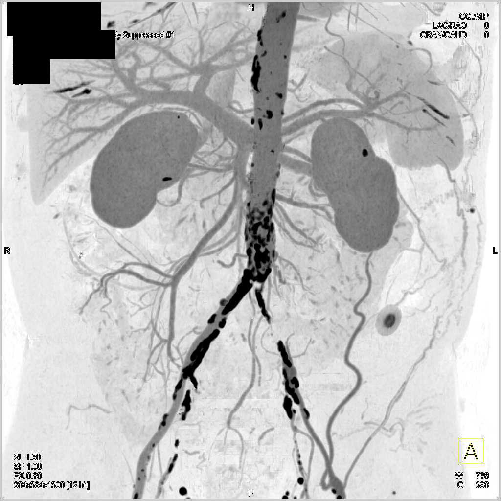 CTA Runoff with Left Common Iliac Artery Occluded - CTisus CT Scan