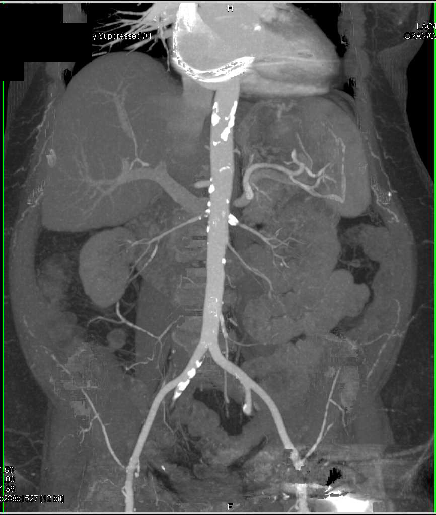 CT Runoff with Pseudo-Occlusion Left Femoral Artery due to Artifact off the Left Total Hip Replacement (THR) - CTisus CT Scan