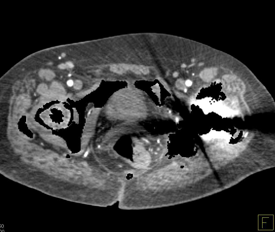 CT Runoff with Pseudo-Occlusion Left Femoral Artery due to Artifact off the Left Total Hip Replacement (THR) - CTisus CT Scan