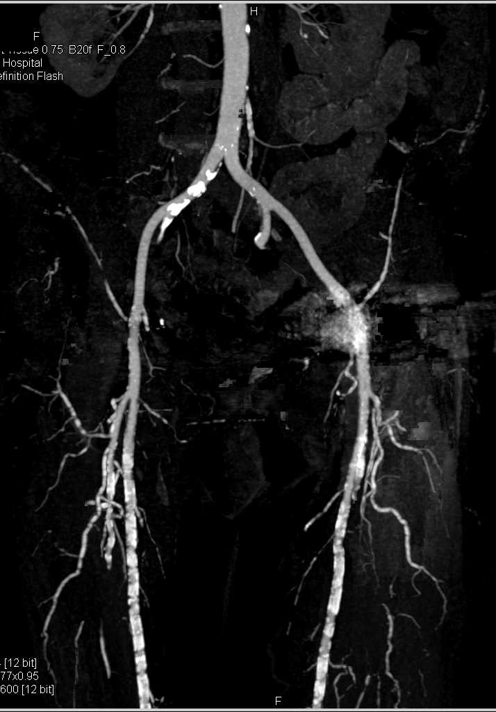 CT Runoff with Pseudo-Occlusion Left Femoral Artery due to Artifact off the Left Total Hip Replacement (THR) - CTisus CT Scan