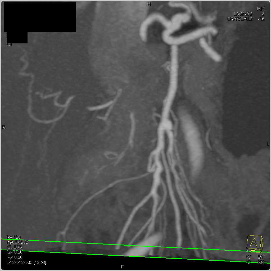 Vascular Disease in the Celiac and SMA - CTisus CT Scan