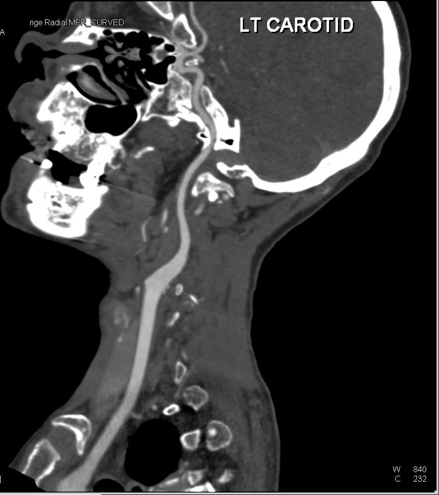 Normal Left Carotid and Vertebral Artery - CTisus CT Scan