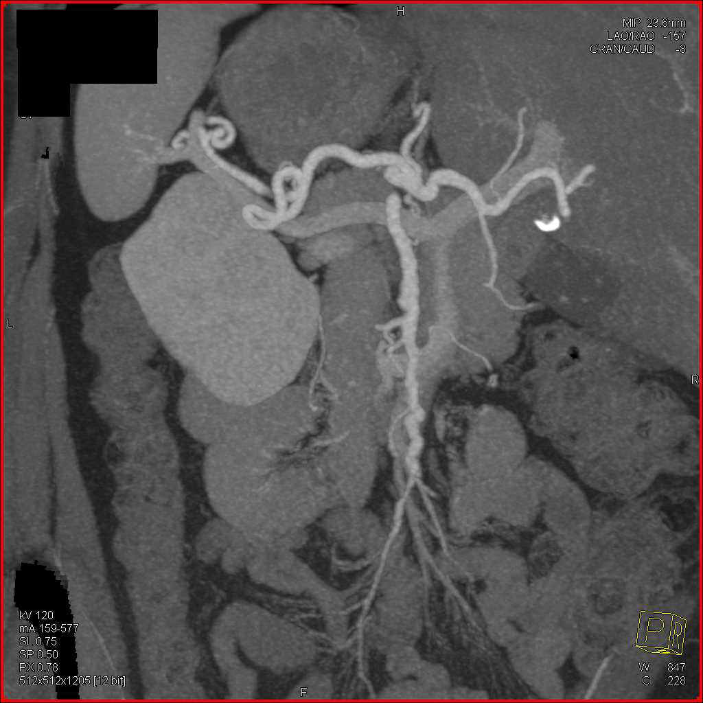 Superior Mesenteric Artery (SMA) Beading due to Vasculitis - CTisus CT Scan