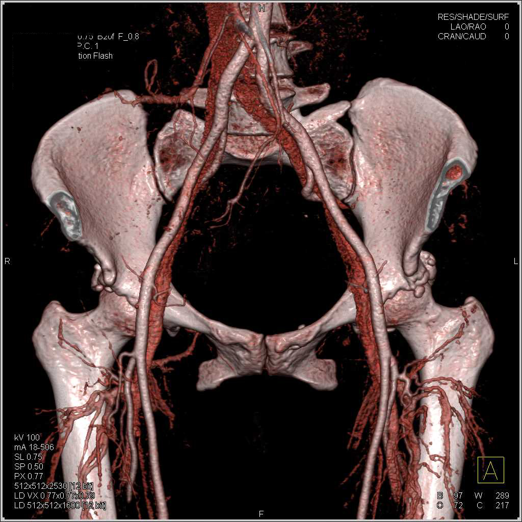 CTA Runoff with Dual Energy CT and Bone Removal Presentations - CTisus CT Scan