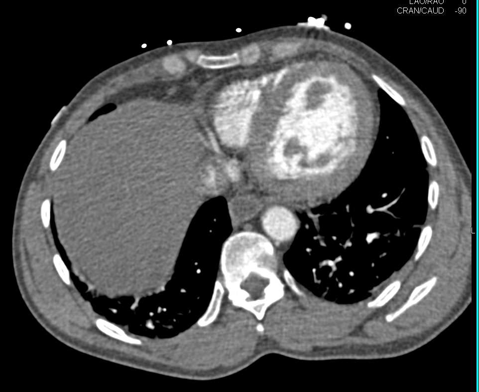 Multiple Emboli to the Kidneys and Mesenteric Vessels - CTisus CT Scan